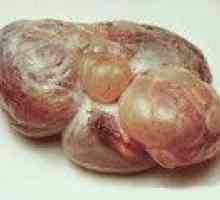 Androblastoma ovar