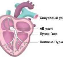 Aritmie cardiacă