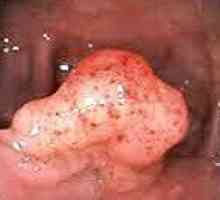 Tumorile benigne ale intestinului gros