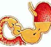Reflux duodeno gastric