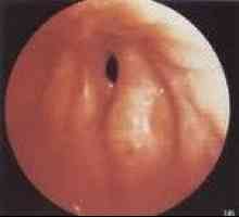 Stenoza cronică a laringelui
