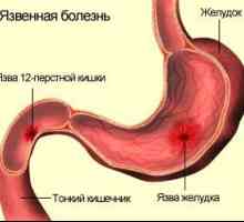 Ulcerele (boala ulcer peptic), stomacului și duodenului