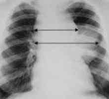Limfom, pulmonar