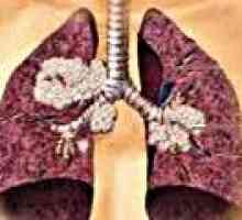 Cancer pulmonar cu celule mici