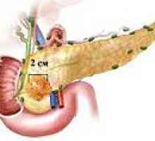 Tumorile pancreasului