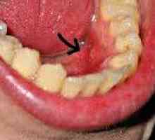 Cancerul oral