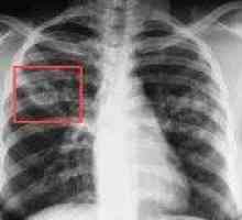 Tuberculoză pulmonară