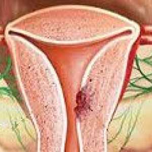 Adenocarcinom uterin