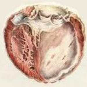 Cardio aterosclerotica