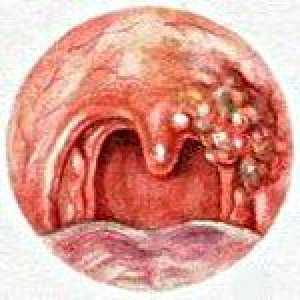 Tumorile benigne ale faringelui