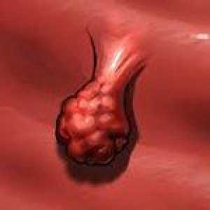 Tumorile benigne ale vaginului