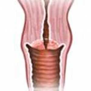 Hipertrofia de col uterin