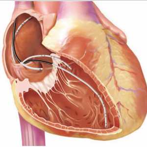 Examinarea electrofiziologice a inimii
