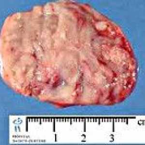 Sympathicoblastoma