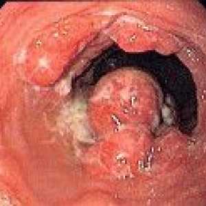 Recurența de cancer la stomac