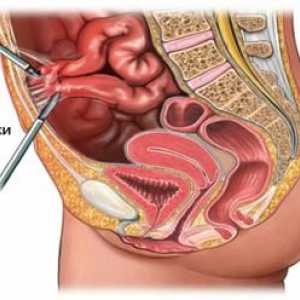 Boala adezivă a cavității abdominale: cauze, simptome si optiuni de tratament