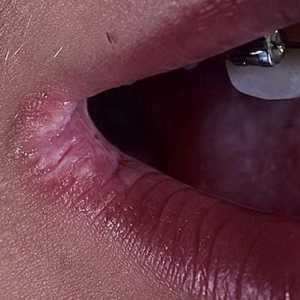 Fisurile „perleches“ în colțurile gurii