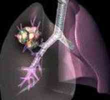 Adenocarcinom pulmonar