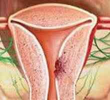 Adenocarcinom uterin