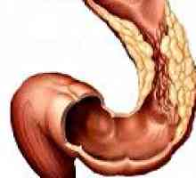 Adenocarcinom de colon
