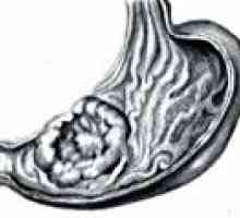 Adenocarcinom gastric