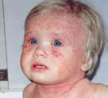 Dermatita atopică la adulți și copii
