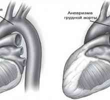 Anevrism aortic