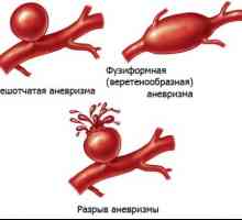Anevrismul arterei renale