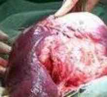 Angiosarcomul ficatului