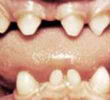 Anomalii de forma dinților