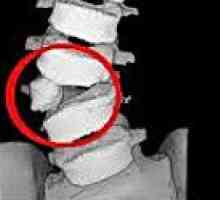 Anomalii ale coloanei vertebrale