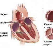 Insuficienta aortica (valva aortica)