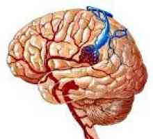 Malformații arterio-venoase ale creierului
