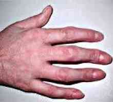 Degete artrită