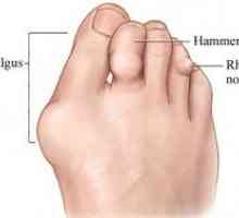 Artrita a articulațiilor degetelor de la picioare