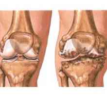 Osteoartrita a genunchiului (gonartroza)