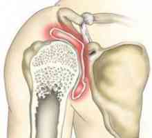 Osteoartrita articulației umărului