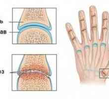 Articulațiilor artritice ale degetelor