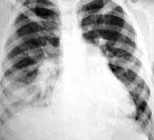Pneumonie inhalare