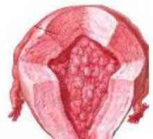 Hiperplazie endometrială atipică