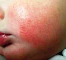 Dermatita atopica la copii