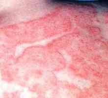 Dermatita atopică la adulți