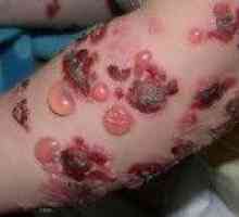 Dermatită buloasă