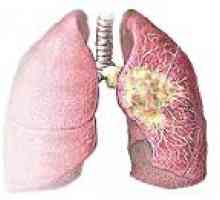 Cancer pulmonar central