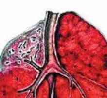 Tuberculoză pulmonară cirozelor