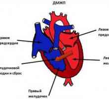 Defect septal ventricular al inimii