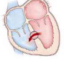 Defect septal ventricular