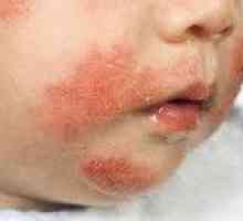 Dermatita la copii
