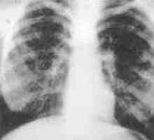 Fibroză pulmonară difuză