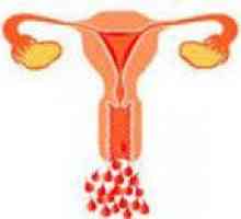 Sângerarea uterină disfuncțională